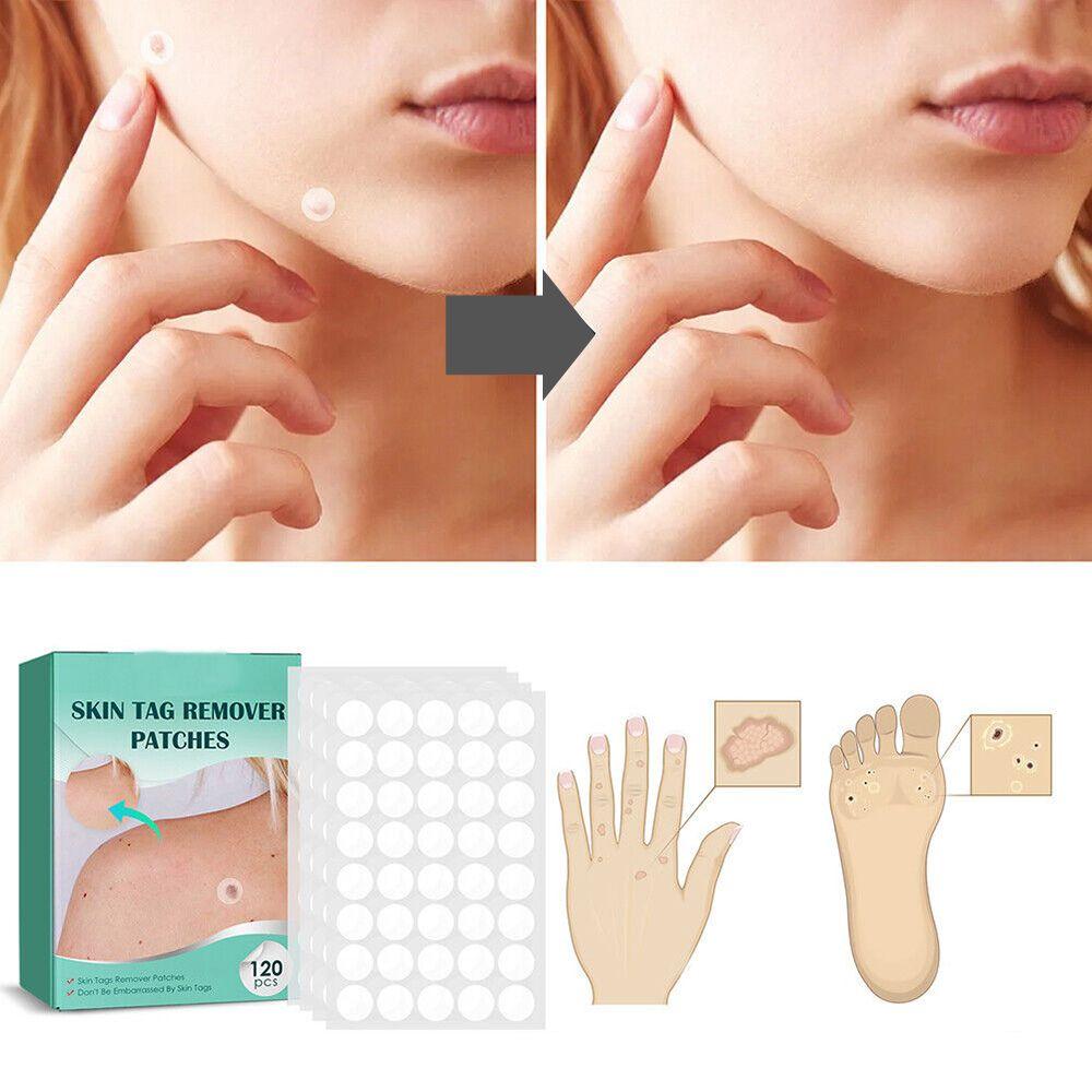 SkinClear - patch for removal of marks and warts