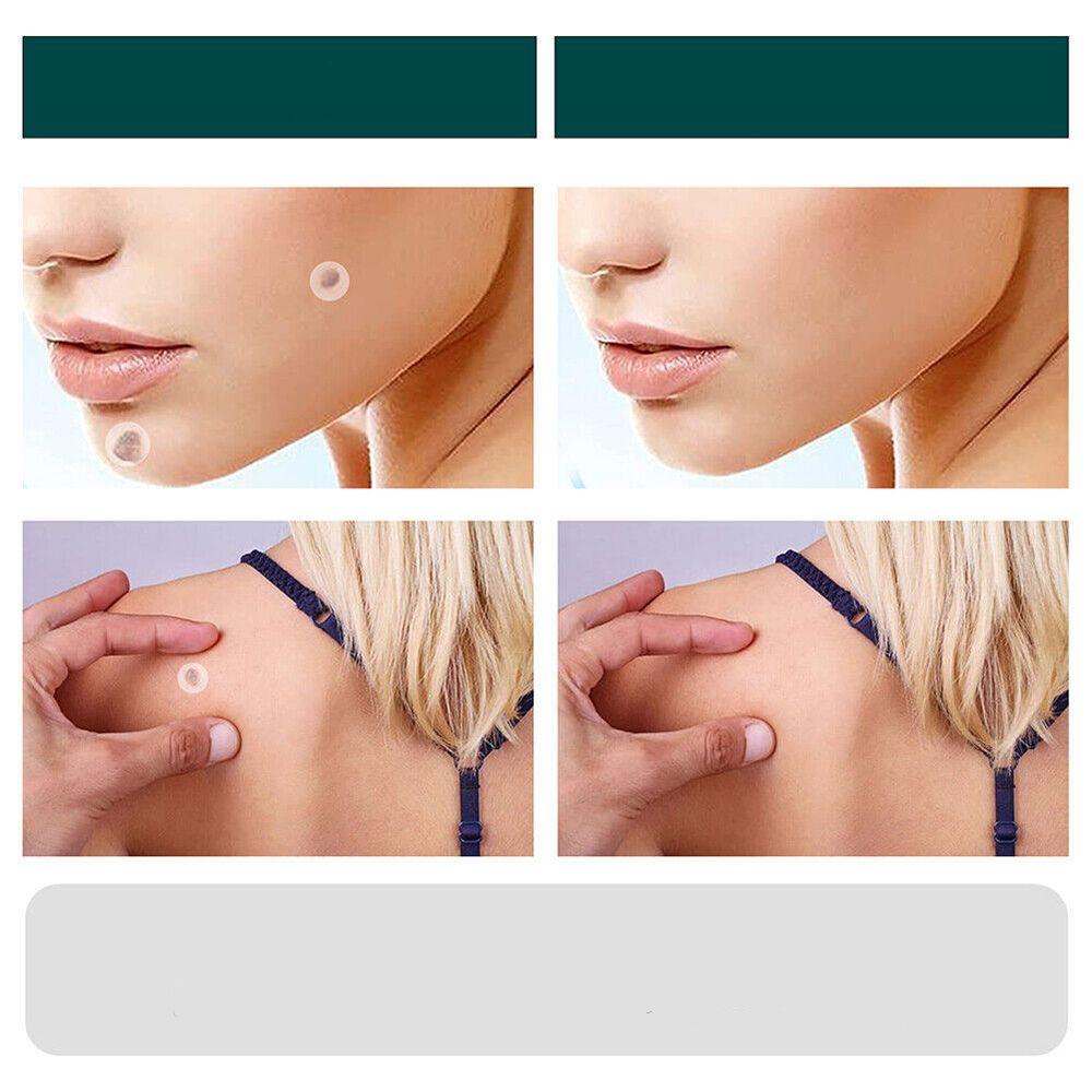 SkinClear - patch for removal of marks and warts