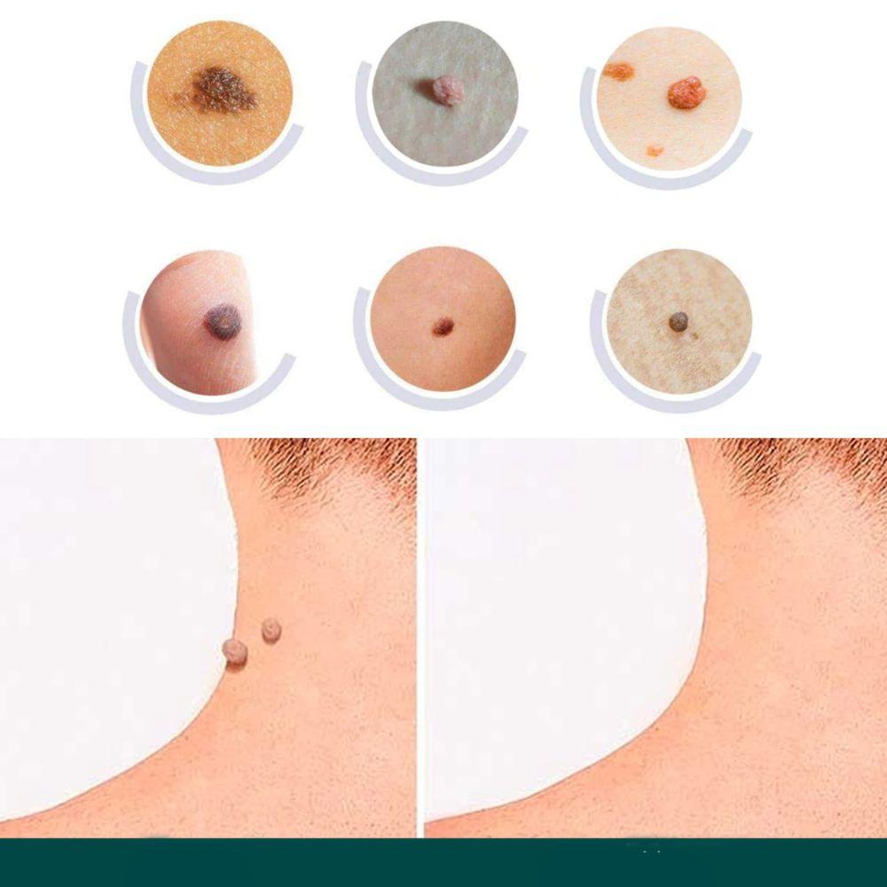 SkinClear - patch for removal of marks and warts